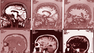 No Brain Scans for Mental Illness